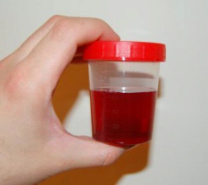 Blut im Urin Hämaturie, Urin Farbe